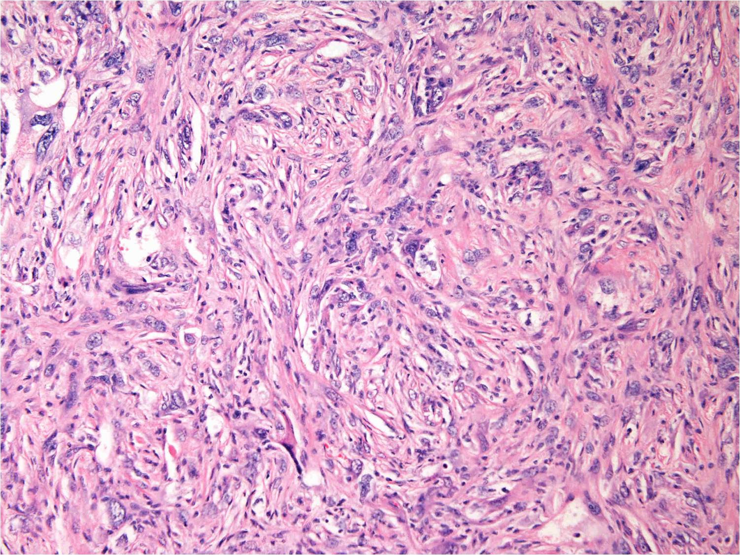 Malignant Fibrous Histiocytoma (MFH) of Bone